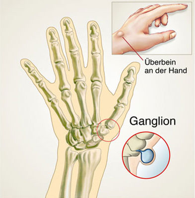 Ganglion