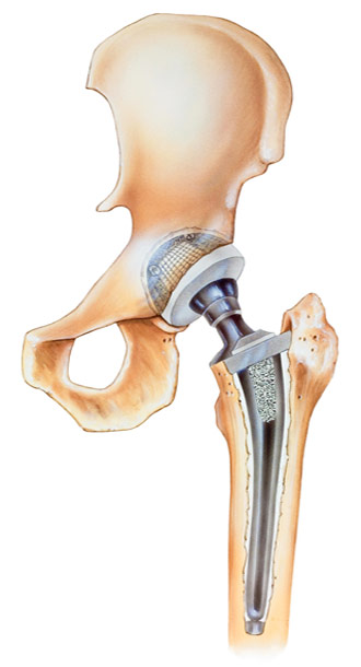 Hüftprothese